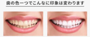 黄ばんでいる歯と白い歯の写真