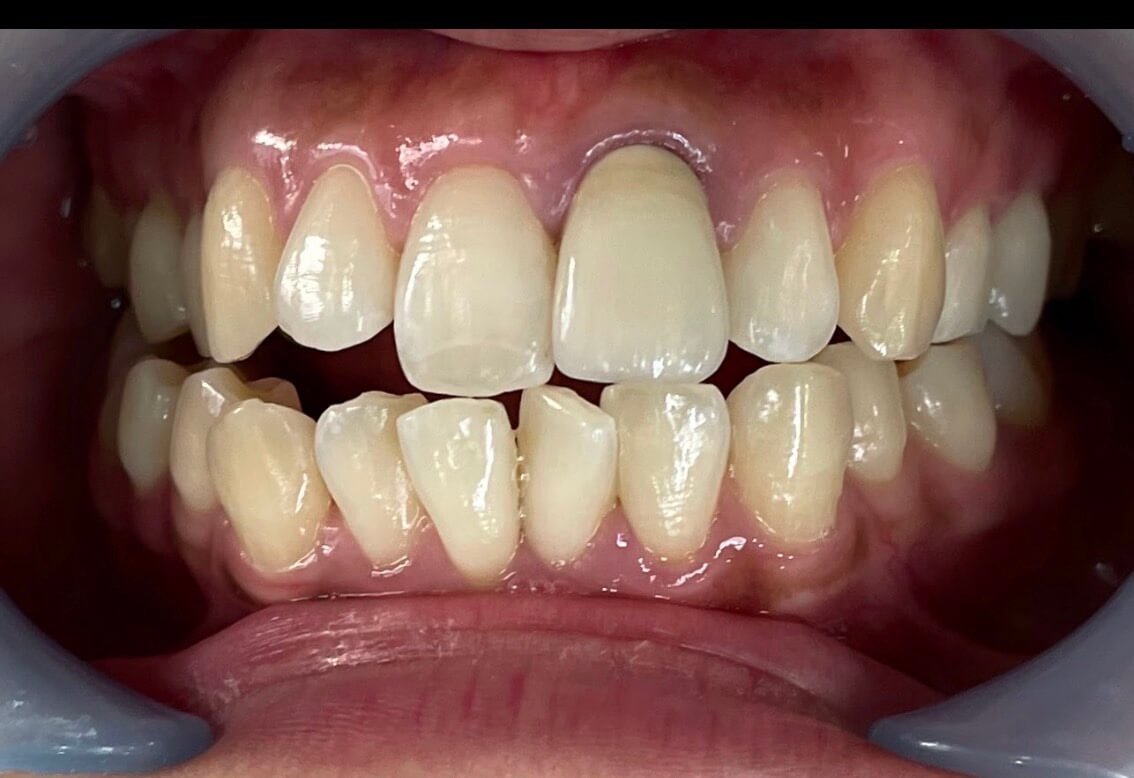 施術前の歯