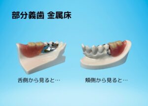 義歯の写真