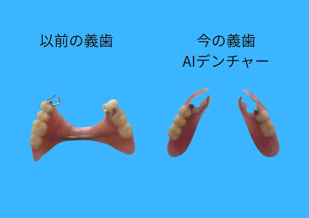 義歯の写真