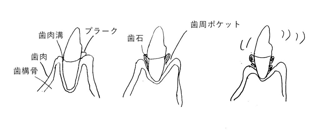 歯周病の様子のイラスト