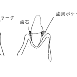 歯周病の様子のイラスト